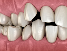 Invisalign can help straighten crowded teeth
