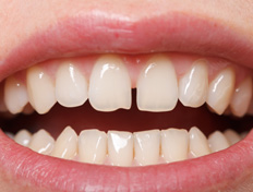 Invisalign can close unsightly gaps between teeth