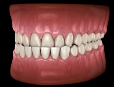 Resolve a crossbite with the help of Invisalign