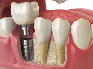 3D model of a dental implant