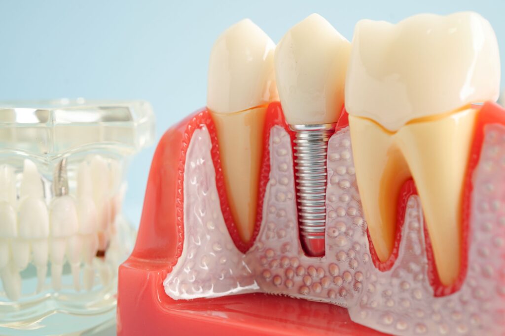 Model dental implant next to artificial teeth with light blue background